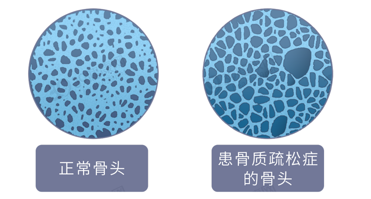 喝骨头汤不补钙！营养师强调：多吃4种补钙食物，预防骨质疏松