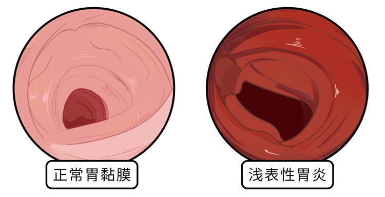 天天熬夜、吃外卖，29岁小伙腹胀消化不良，检查时已是胃癌